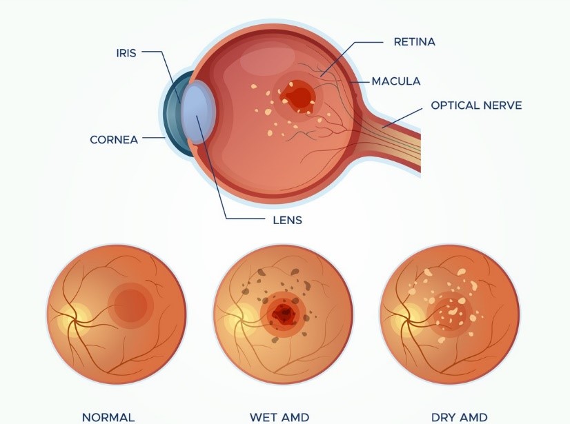 A diagram of a human eye, macular degeneration