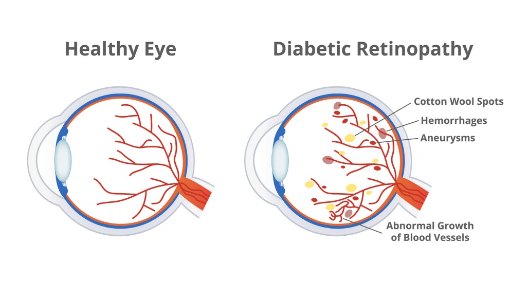 Diabetic Eye Care, A diagram of a healthy eye and a diabetics eye