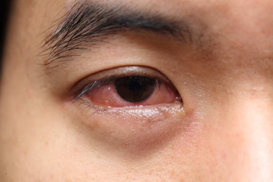 Family Eye Care, Bloodshot and inflamed eye with white crusting on the lower eyelid, possibly conjunctivitis.